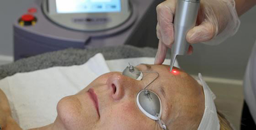 tri-nam-175-2-ngoisao 3 điều trị nám, tàn nhang, xóa bớt chàm, BB Thanh Mai