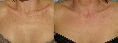 tri-nam-175-3-ngoisao 2 điều trị nám, tàn nhang, xóa bớt chàm, BB Thanh Mai