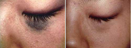 tri-nam-175-4-ngoisao 1 điều trị nám, tàn nhang, xóa bớt chàm, BB Thanh Mai