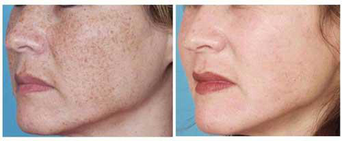 tri-nam-175-5-ngoisao 0 điều trị nám, tàn nhang, xóa bớt chàm, BB Thanh Mai