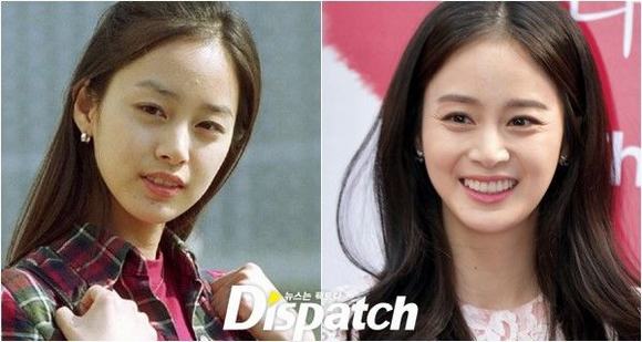 Sao Hàn, sao hàn chỉnh răng, Kim Tae Hee, 