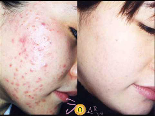 Trị mụn, Trị mụn công nghệ cao, Solar spa