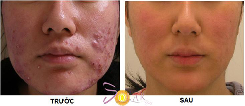 Trị mụn, Trị mụn công nghệ cao, Solar spa