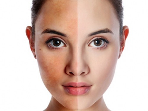 Trị nám da, Trị nám tận gốc, Chăm sóc da, Thẩm mỹ viện Thiên Hà