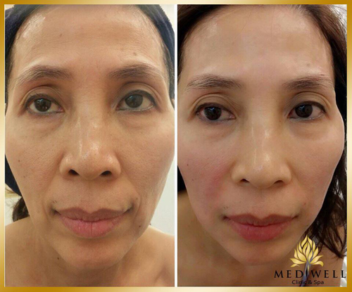 Mediwell spa, Trẻ hóa da, Lão hóa da