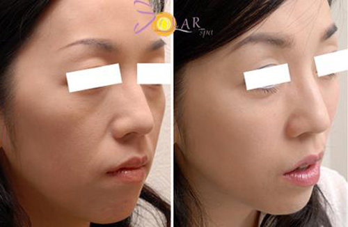 solar-spa-26-2-ngoisao 3 Trẻ hóa da, Da mặt trắng hồng, Chăm sóc da, Solar spa