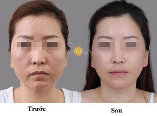 solar-spa-26-3-ngoisao 2 Trẻ hóa da, Da mặt trắng hồng, Chăm sóc da, Solar spa