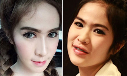 cô gái cắt môi, cắt môi, phẫu thuật cắt môi, thẩm mỹ môi