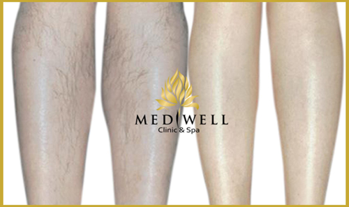 Triệt lông 6G, Triệt lông vĩnh viễn, Mediwell spa, Triệt lông giá rẻ