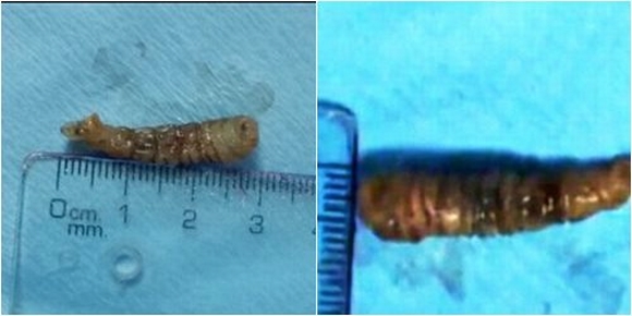 sâu dài 3cm sống trong mắt, sâu trong mắt, kỳ lạ , chuyện lạ, kỳ qua quặc