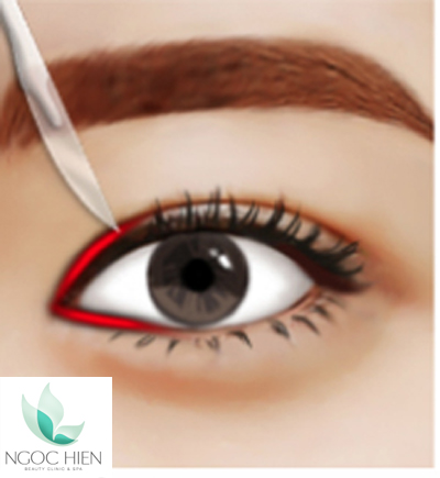 Phẫu thuật chỉnh hình góc mắt, Phẫu thuật mắt, Viện thẩm mỹ Ngọc Hiền, Tạo hình mí mắt công nghệ Hàn Quốc