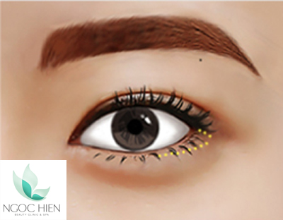 Phẫu thuật chỉnh hình góc mắt, Phẫu thuật mắt, Viện thẩm mỹ Ngọc Hiền, Tạo hình mí mắt công nghệ Hàn Quốc