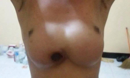 Người phụ nữ Thái Lan bị 'thủng' ngực vì phẫu thuật thẩm mỹ