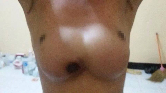 người phụ nữ Thái Lan,phụ nữ Thái bị thủng ngực,phụ nữ Thái thẩm mỹ vòng một,bị thủng ngực vì thẩm mỹ