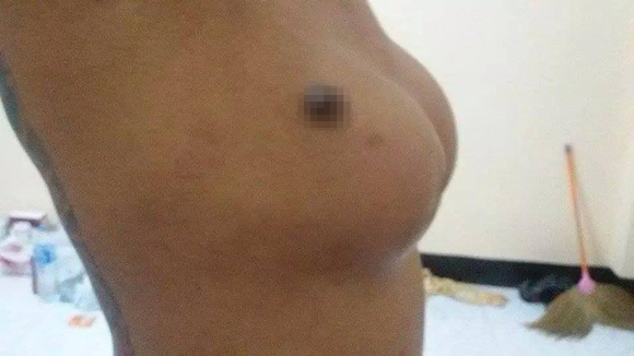 người phụ nữ Thái Lan,phụ nữ Thái bị thủng ngực,phụ nữ Thái thẩm mỹ vòng một,bị thủng ngực vì thẩm mỹ