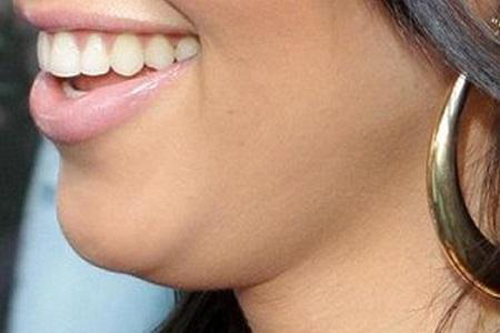 Xóa bỏ nọng cằm, BB Thanh Mai, Thẩm mỹ viện uy tín, BB Thanh Mai khuyến mại