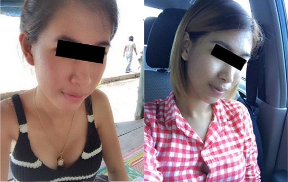 cô gái lở loét vì mua kem qua mạng, cô gái lở loét, cô gái lở loét vì dùng kem trị mụn, lở loét vì kem trị mụn