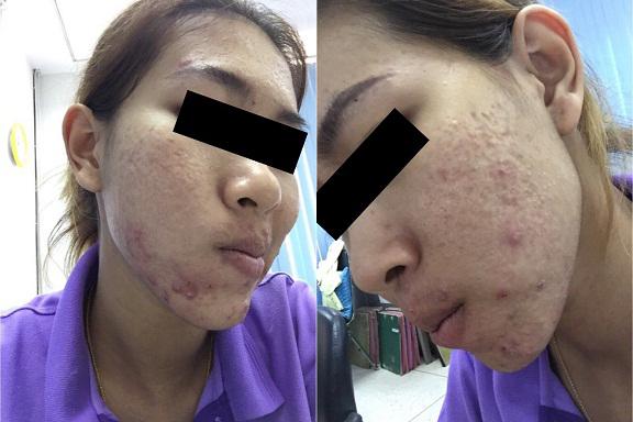cô gái lở loét vì mua kem qua mạng, cô gái lở loét, cô gái lở loét vì dùng kem trị mụn, lở loét vì kem trị mụn