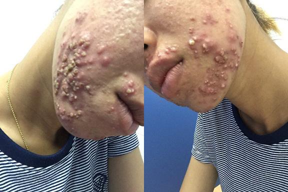 cô gái lở loét vì mua kem qua mạng, cô gái lở loét, cô gái lở loét vì dùng kem trị mụn, lở loét vì kem trị mụn