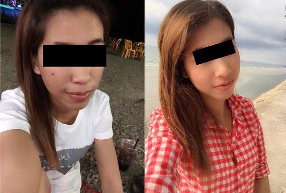 cô gái lở loét vì mua kem qua mạng, cô gái lở loét, cô gái lở loét vì dùng kem trị mụn, lở loét vì kem trị mụn