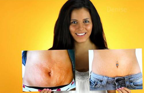 Trị rạn da, Kem trị rạn da, Xóa vết rạn da, TriLastin Body Contour System 2