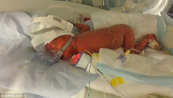 em bé sinh non,em bé sinh non 4 tháng tuổi,bộ ảnh 100 ngày chuyển biến của em bé sinh non,em bé sinh non Lenny Harrison