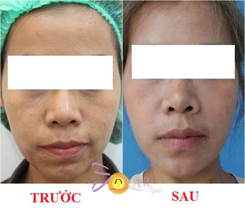 Solar spa, Xóa vết nhăn 1 lần duy nhất, Xáo vết nhăn