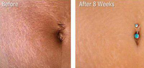 Xóa rạn da sau sinh, Rạn da sau sinh, Kem xóa rạn da