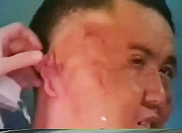 người đàn ông mọc thêm miệng và não,người đàn ông kỳ dị,Chang Tzu Ping,Chang Tzu Ping bị rối loạn phát triển cơ thể