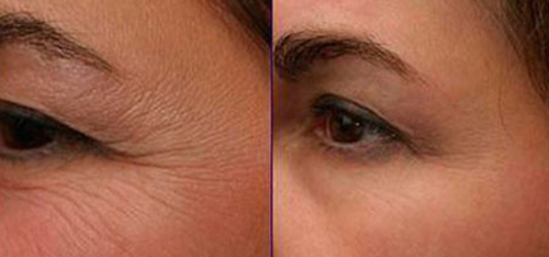 bb-thanh-mai-217-2-ngoisao 3 Trẻ hóa da, Công nghệ sóng cao tần, BB Thanh Mai, Xóa nhăn