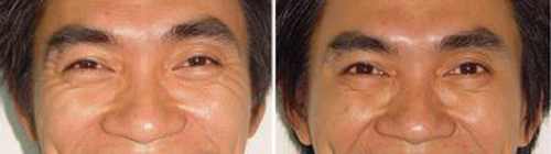 bb-thanh-mai-217-3-ngoisao 2 Trẻ hóa da, Công nghệ sóng cao tần, BB Thanh Mai, Xóa nhăn