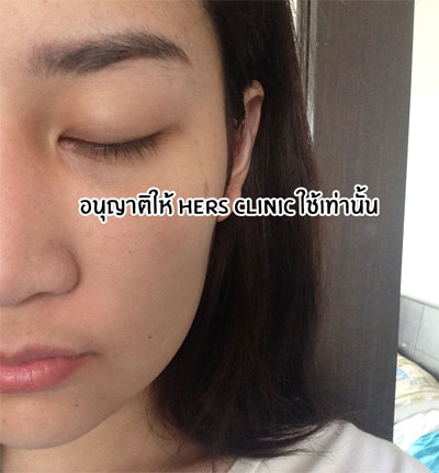 cắt thịt ở má,cô nàng Thái Lan cắt thịt ở má,phẫu thuật để có gương mặt thon gọn,cắt thịt ở má tại bệnh viện thẩm mỹ,Bangkok