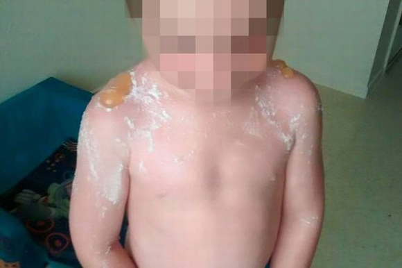  bé 7 tuổi bị bỏng phồng rộp vì cháy nắng, i bị bỏng phồng rộp, cháy nắng, tin ngôi sao