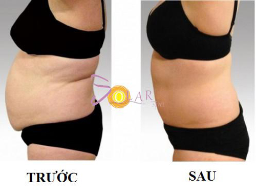 giam-beo-khong-phau-thuat-287-3-ngoisao 1 giảm béo không phẫu thuật, solar spa, solar spa khuyến mại