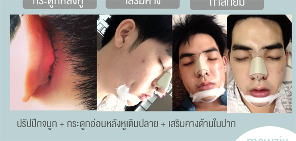 hot boy Thái Lan,Mewzix Suradat,hot boy Thái Lan làm lại cả hàm răng,hot boy Thái Lan thẩm mỹ đau đớn