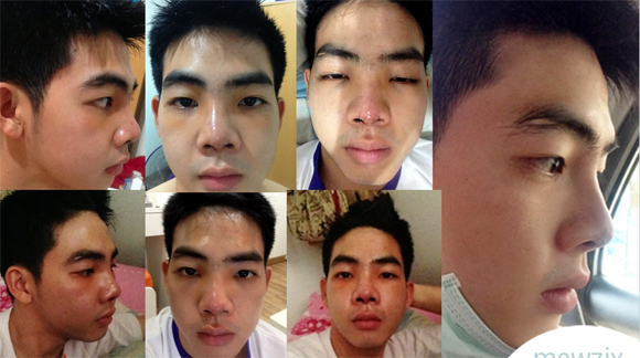 hot boy Thái Lan,Mewzix Suradat,hot boy Thái Lan làm lại cả hàm răng,hot boy Thái Lan thẩm mỹ đau đớn