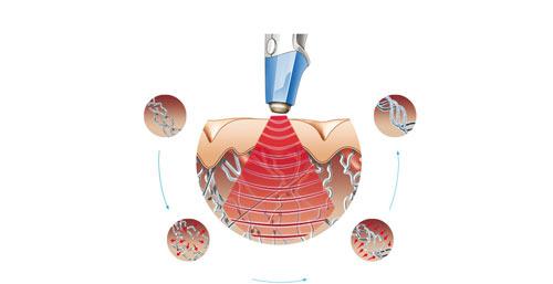 vùng kín sau sinh, BB Thanh Mai, Trẻ hóa vùng kín