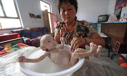 em bé không có hậu môn, em bé không có bộ phân sinh dục, em bé,  bé Lý Thị Thu Anh ở buôn K’Doh, xã Ea Ta, huyện Cư M’Gar, Đắk Lắk.