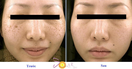 Solar Spa, Trẻ hóa da, Trẻ hóa da công nghệ cao, Solar Spa khuyến mại