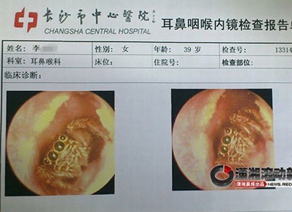 côn trùng khủng chui vào tai, rết chui vào tai, gián chui vào tai, côn trùng, kỳ lạ, kỳ quặc, tin ngôi sao