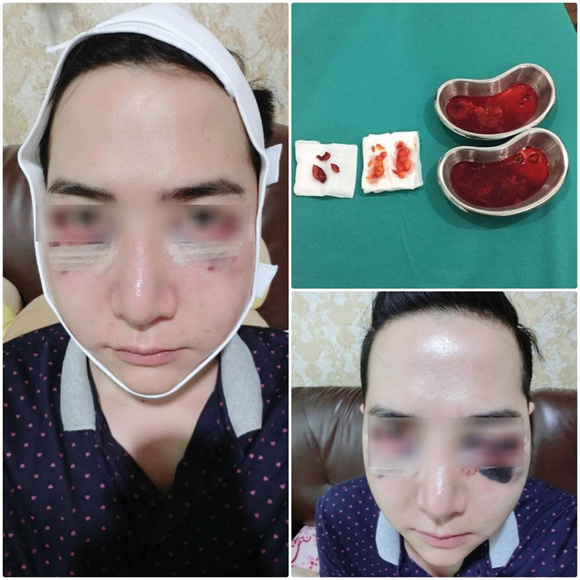 chàng trai trẻ Thái Lan,Nook,chàng trai trẻ Thái Lan biến dạng khuôn mặt,chàng trai trẻ Thái Lan nâng má,chàng trai trẻ Thái Lan tiêm silicon lỏng vào mặt