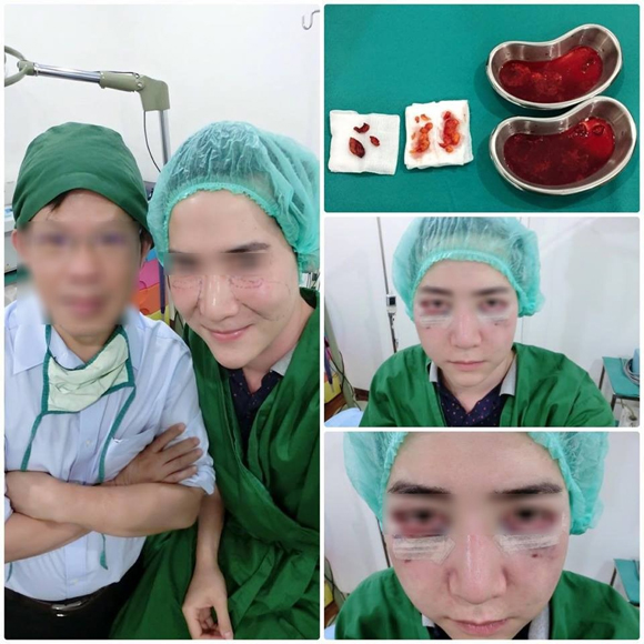 chàng trai trẻ Thái Lan,Nook,chàng trai trẻ Thái Lan biến dạng khuôn mặt,chàng trai trẻ Thái Lan nâng má,chàng trai trẻ Thái Lan tiêm silicon lỏng vào mặt