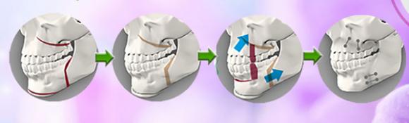 Nguyễn Thị Lan, Diễn viên múa phẫu thuật hóa thiên nga, Thẩm mỹ viện Hàn Quốc JW