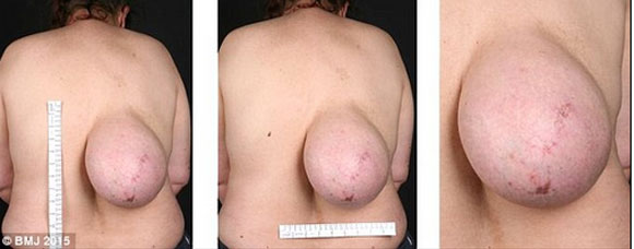 người phụ nữ bị mọc khối u,người phụ nữ bị mọc ngực ở lưng,người phụ nữ có khối u ở lưng, kỳ quặc thế giới