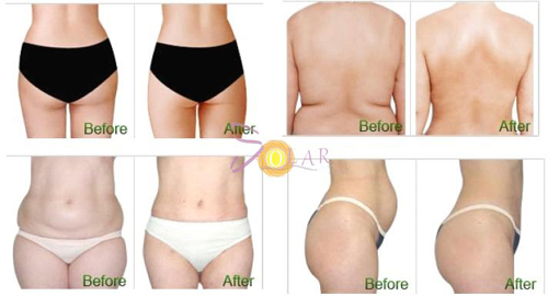 giam-beo-mot-lan-duy-nhat-219-1-ngoisao 2 Giảm béo một lần duy nhất, Công nghệ giảm béo, Solar spa