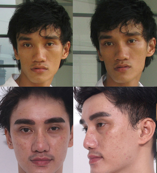Hà Nhuận Nam, Bệnh viện Thẩm mỹ Hiệp Lợi, Lột xác nhờ phẫu thuật thẩm mỹ