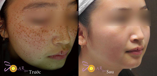 solar-spa-1610-3-ngoisao 0 Solar Spa, Tắm trắng, Xóa tàn nhang