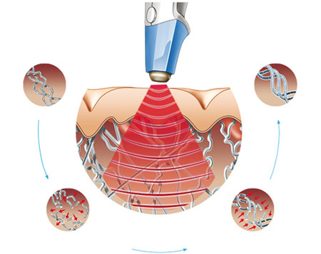 Lão hóa vùng kín, Trẻ hóa vùng kín, BB Beauté – BB Thanh Mai