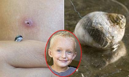 Kinh hãi: Ốc sên sống trong đầu gối cậu bé 7 tuổi