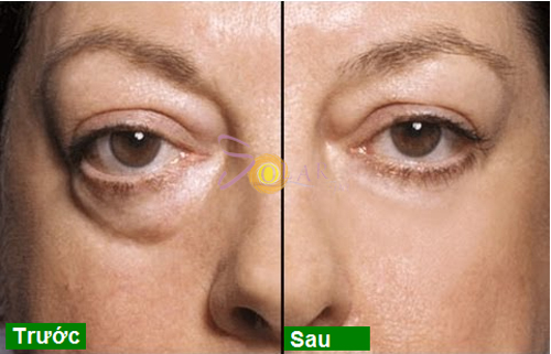 Xóa nhăn, Đánh tan bọng mỡ mắt, Solar spa, Công nghệ Thermage CPT